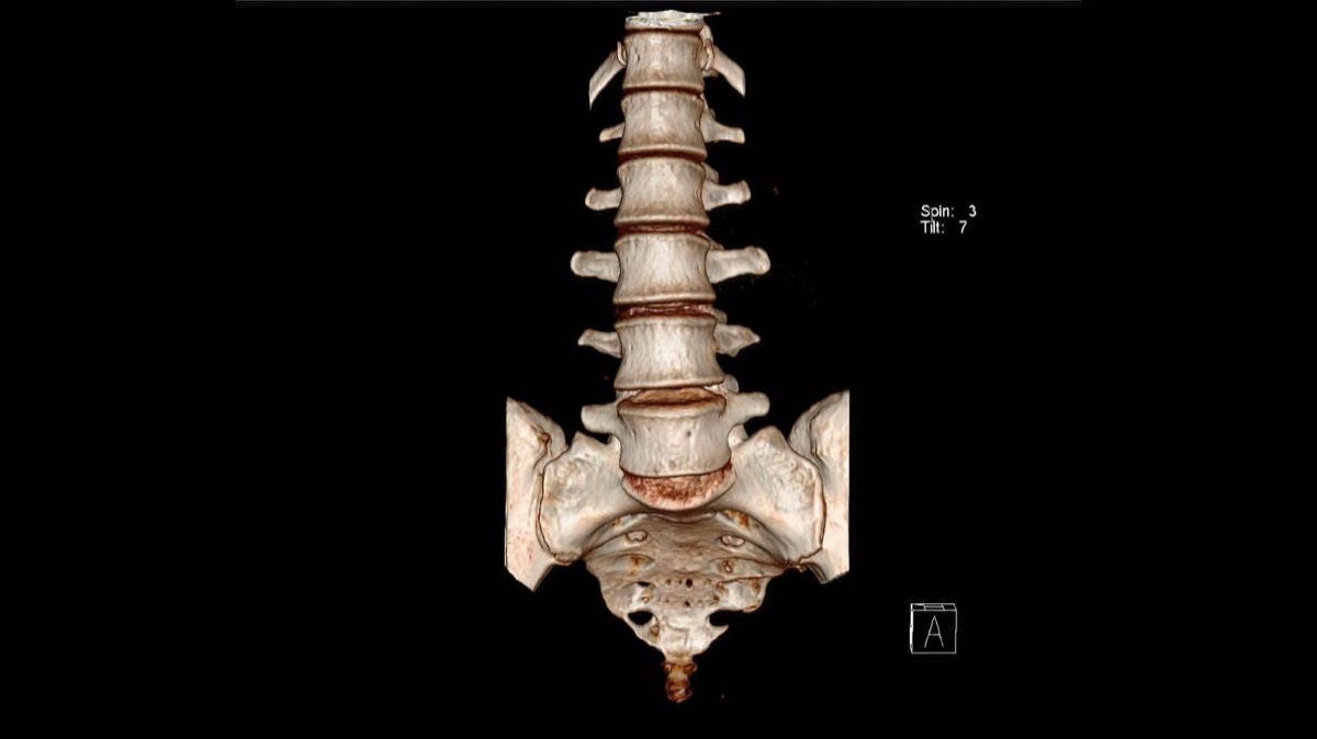 שחזור תלת־ממדי בסריקת CT של חוליות הגב התחתון ועצם העצה על רקע שחור